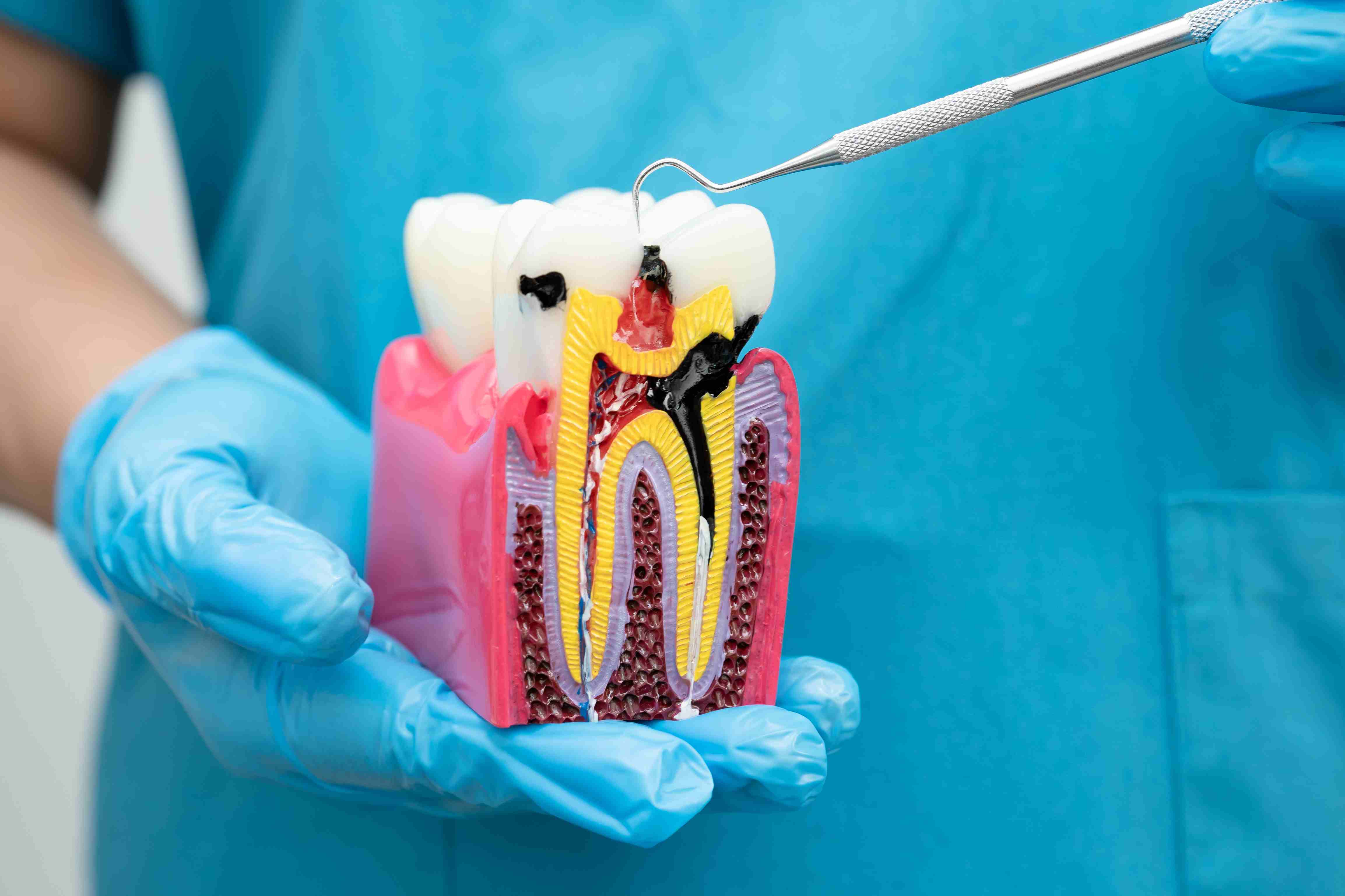 What is Root Canal Treatment?